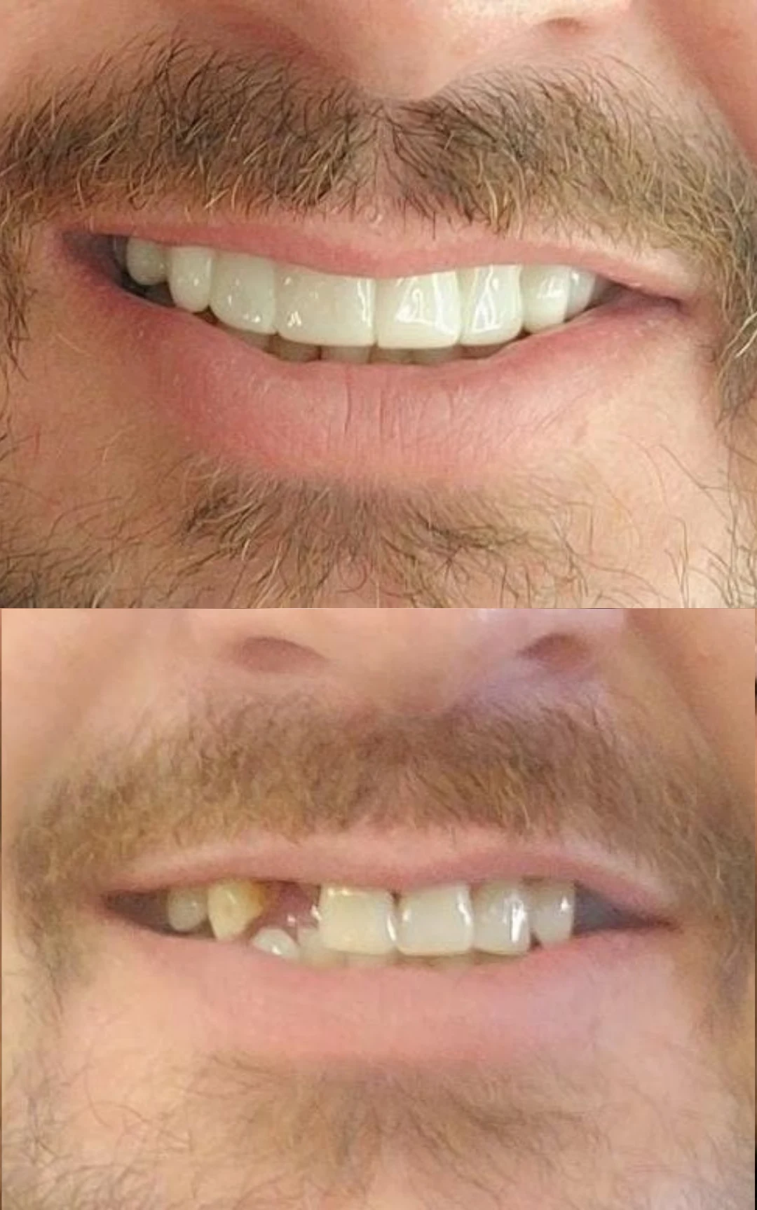 Worn Down Teeth after