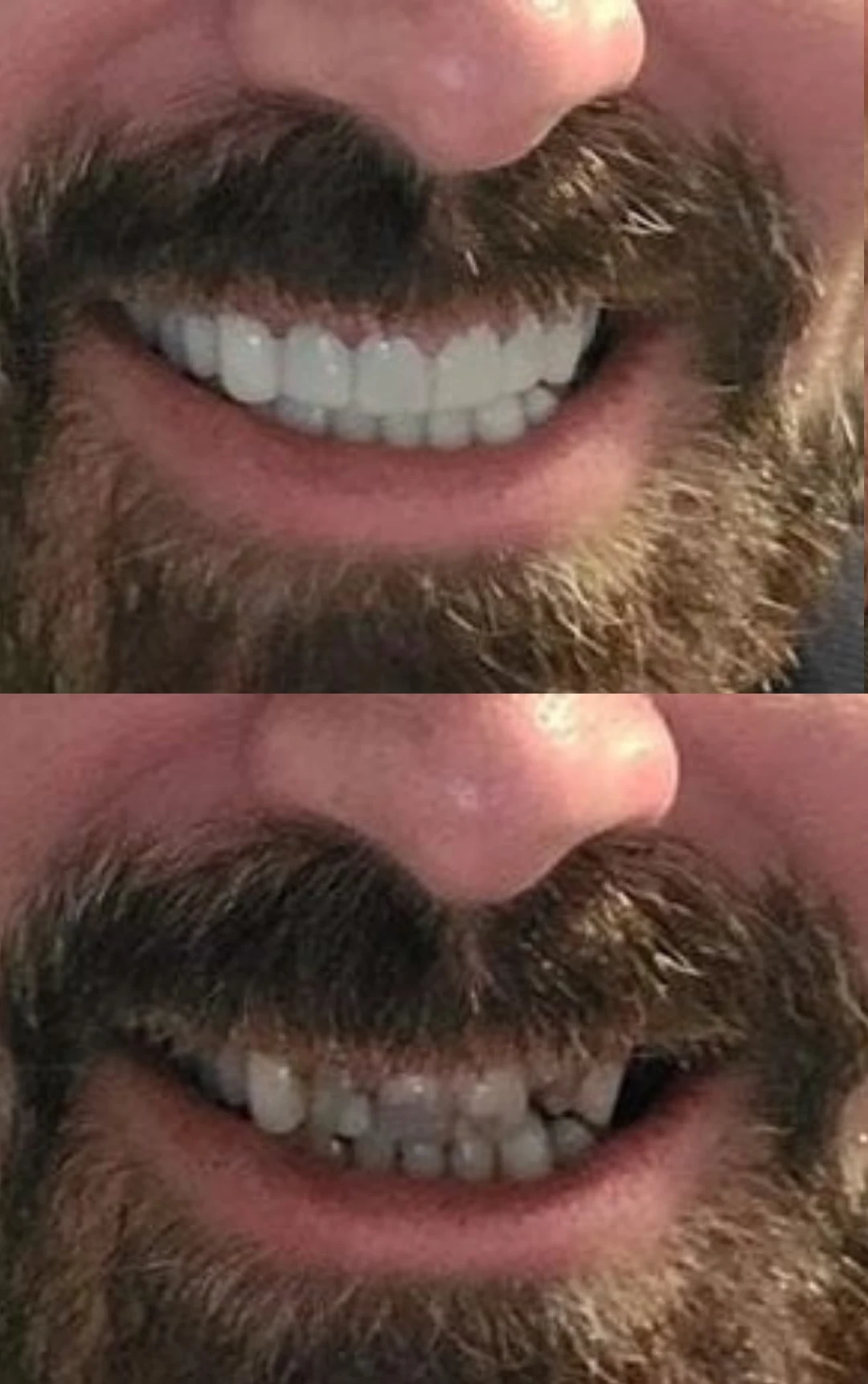 Crooked Teeth after